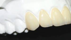 Zirconia Dental Lab Pic