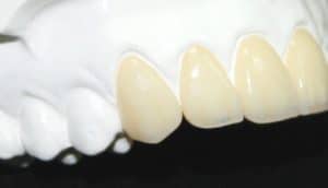 The Art Of Aesthetics Crowns and Bridges Dental Laboratory Zirconia Dental Lab Pic