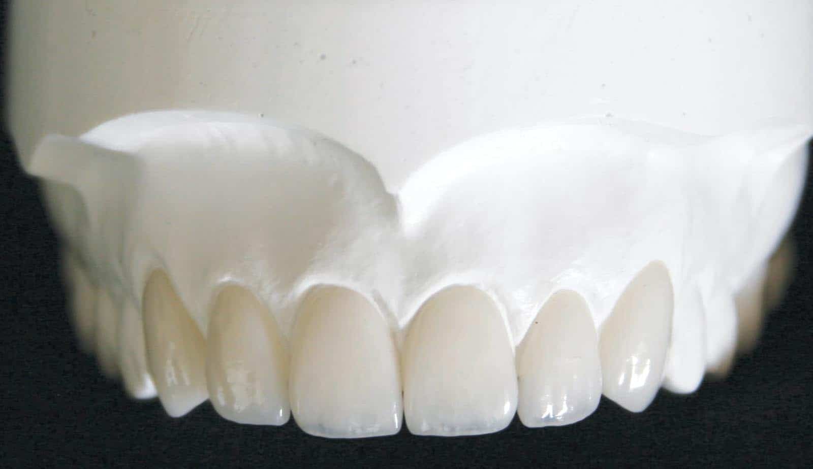 Dental Cosmetic Lab Veneers Image