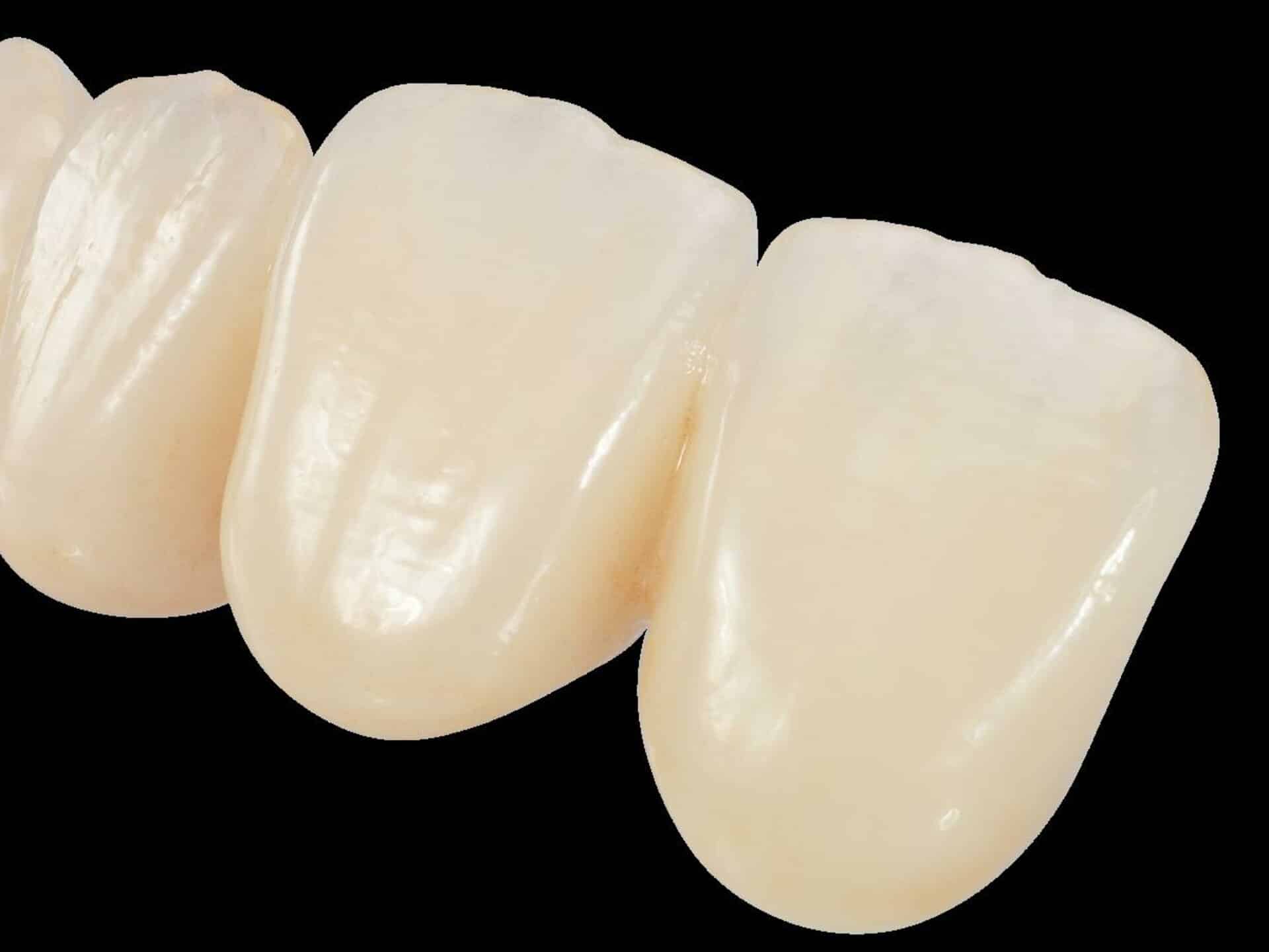 Emax cosmetic dental lab image