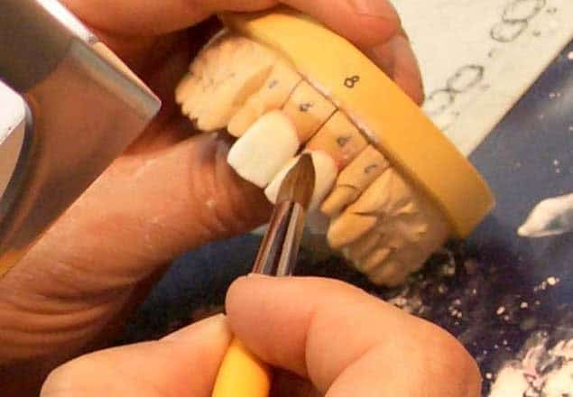 Dental Lab in Beverly Hills image 1 Dental technician fabricating a ceramic crown in a modern dental laboratory